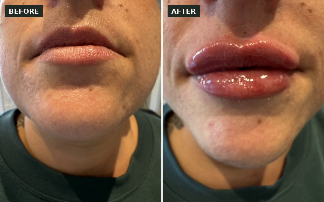 Lip enhancement case study before and after