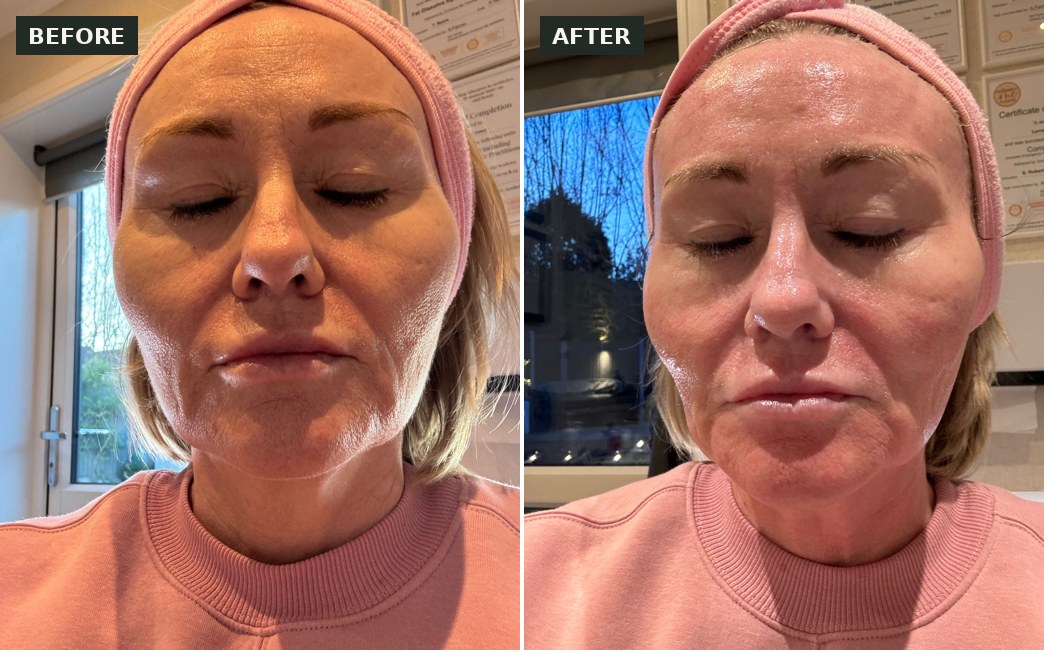 Microneedling before and after at The Elegance Clinic, Welwyn Garden City