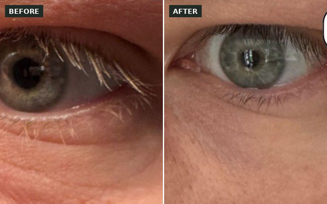 Polynucleotides under-eye before and after at The Elegance Clinic, Welwyn Garden City