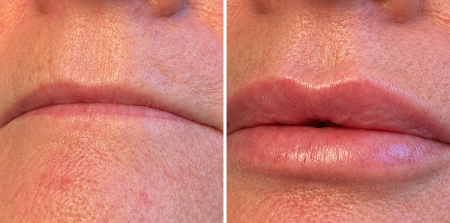Dermal and lip filler result