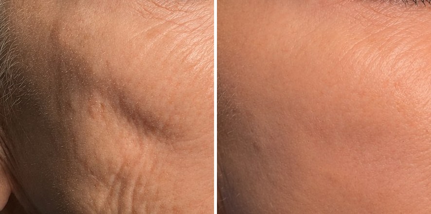 Sculptra jawline and cheek result at The Elegance Clinic, Welwyn Garden City