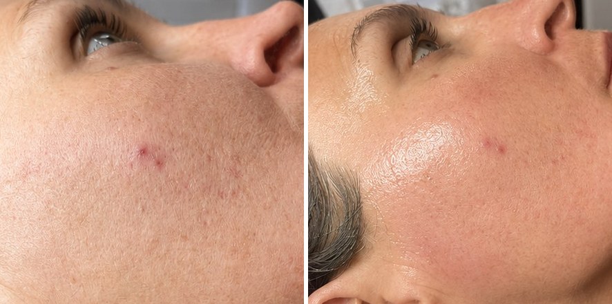 Microneedling and skin-health result