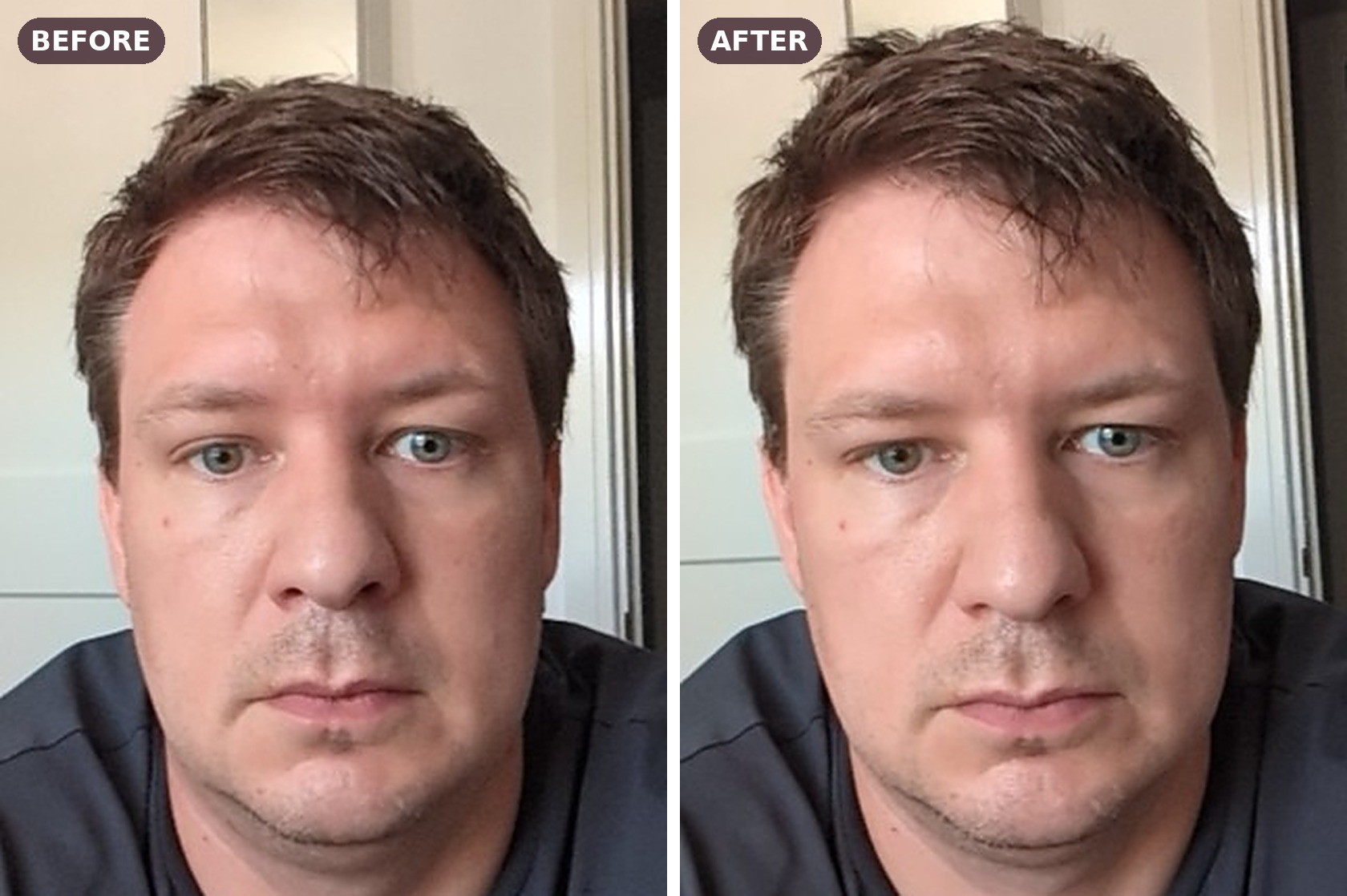 Men's anti-wrinkle before and after — frown and forehead lines softened at The Elegance Clinic, Welwyn Garden City