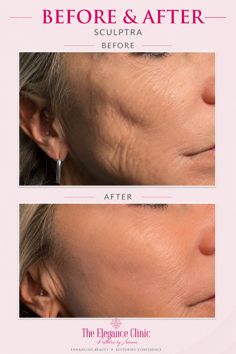 Sculptra before and after at The Elegance Clinic, Welwyn Garden City