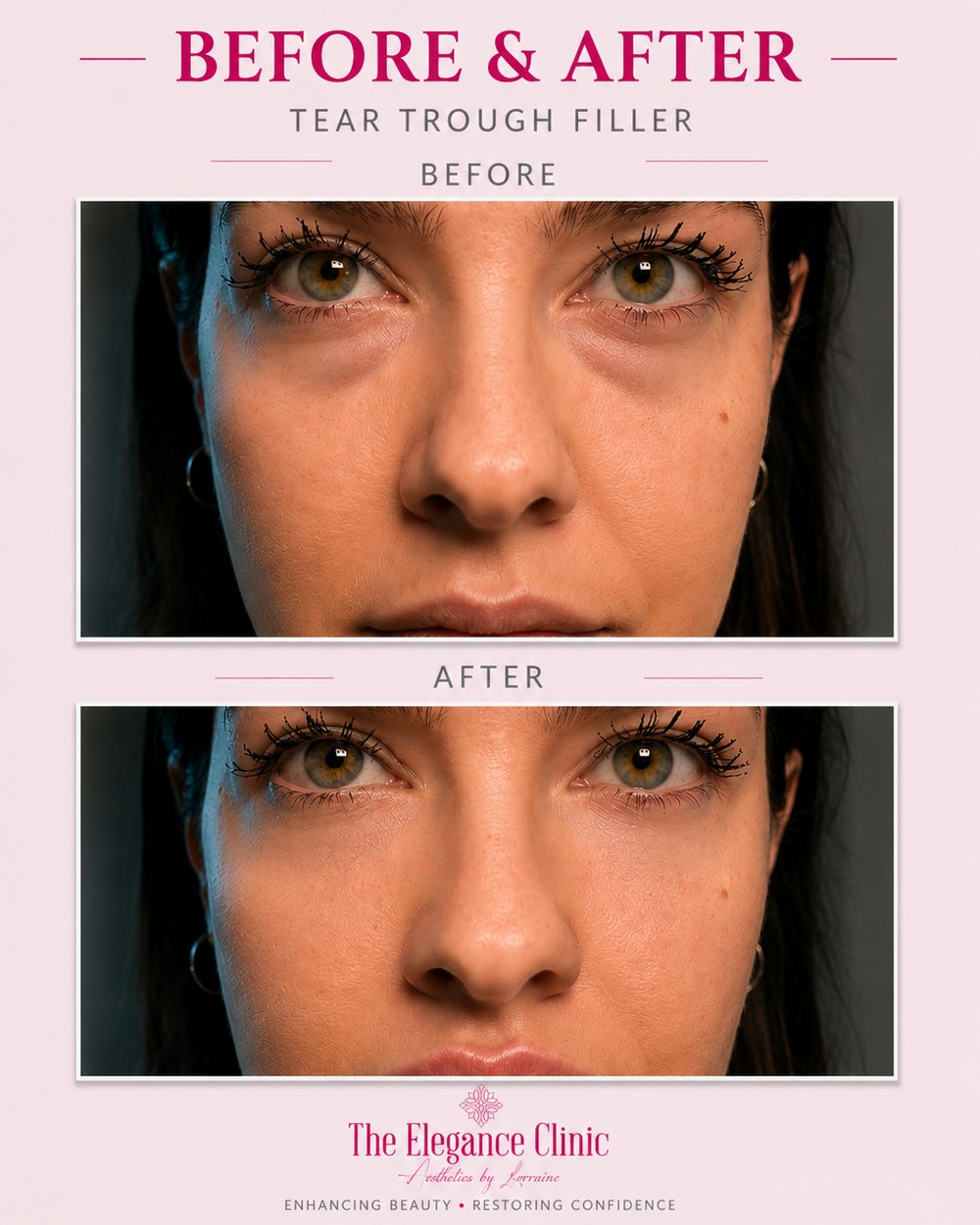 Tear Trough Filler before and after at The Elegance Clinic, Welwyn Garden City