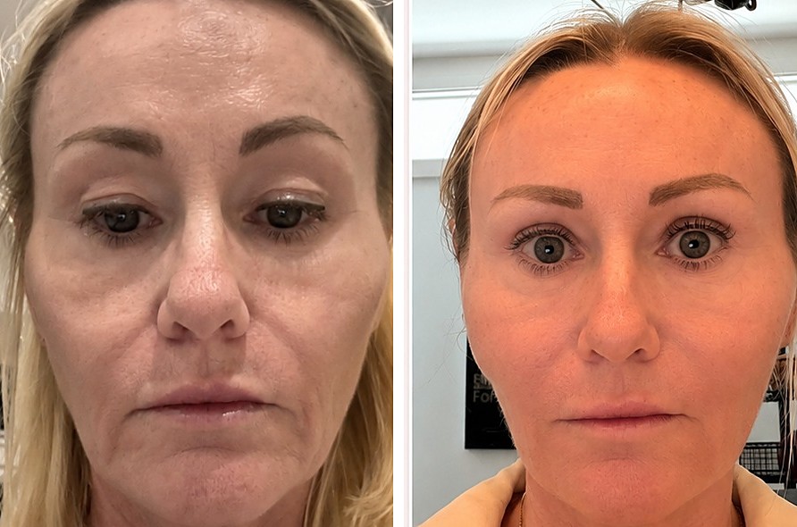 Sculptra before and after — natural, renewed skin at The Elegance Clinic, Welwyn Garden City