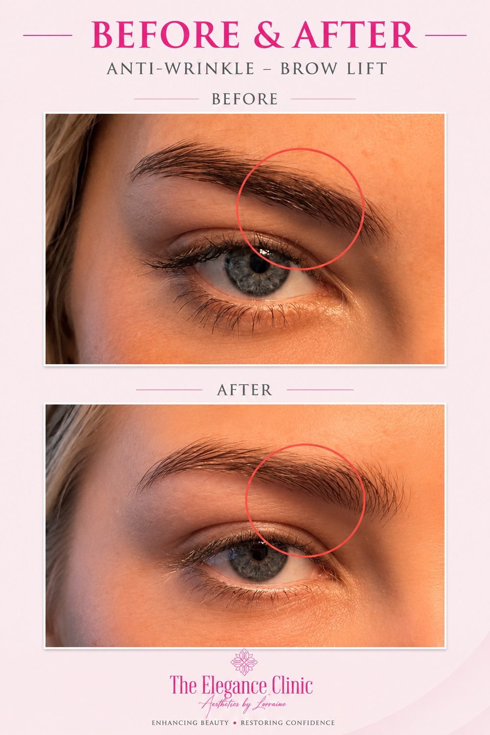Anti-wrinkle before and after at The Elegance Clinic, Welwyn Garden City