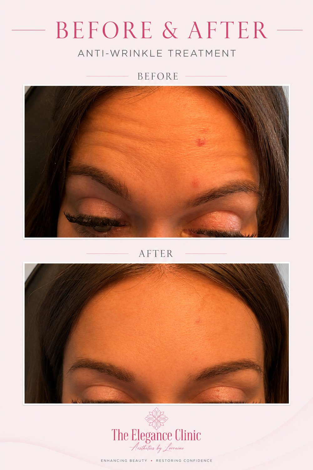 Anti-wrinkle before and after at The Elegance Clinic, Welwyn Garden City