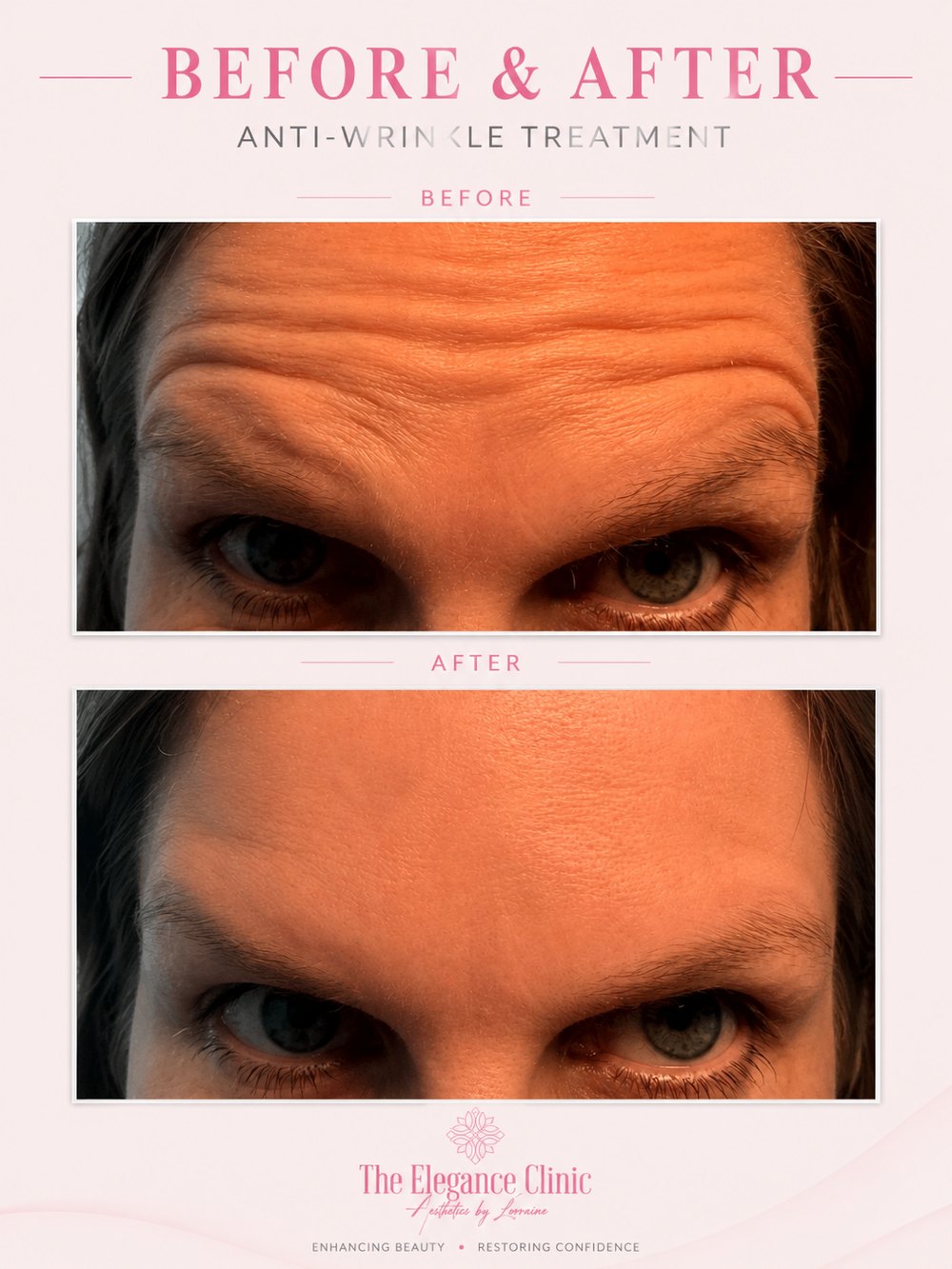 Anti-wrinkle before and after at The Elegance Clinic, Welwyn Garden City
