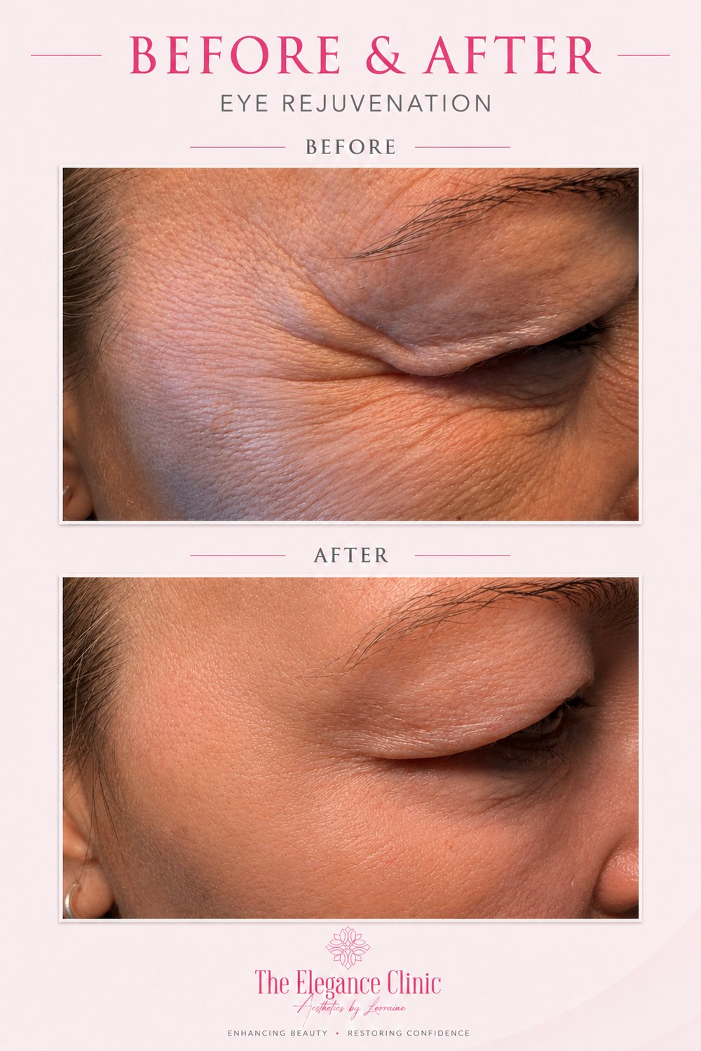 Anti-wrinkle before and after at The Elegance Clinic, Welwyn Garden City