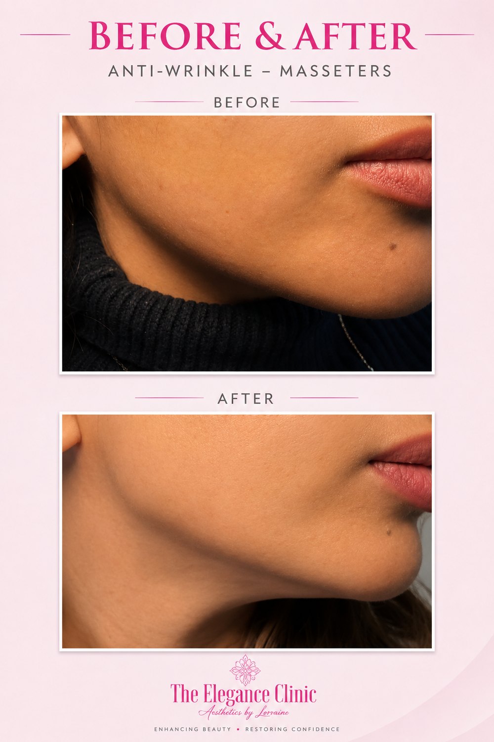Anti-wrinkle before and after at The Elegance Clinic, Welwyn Garden City