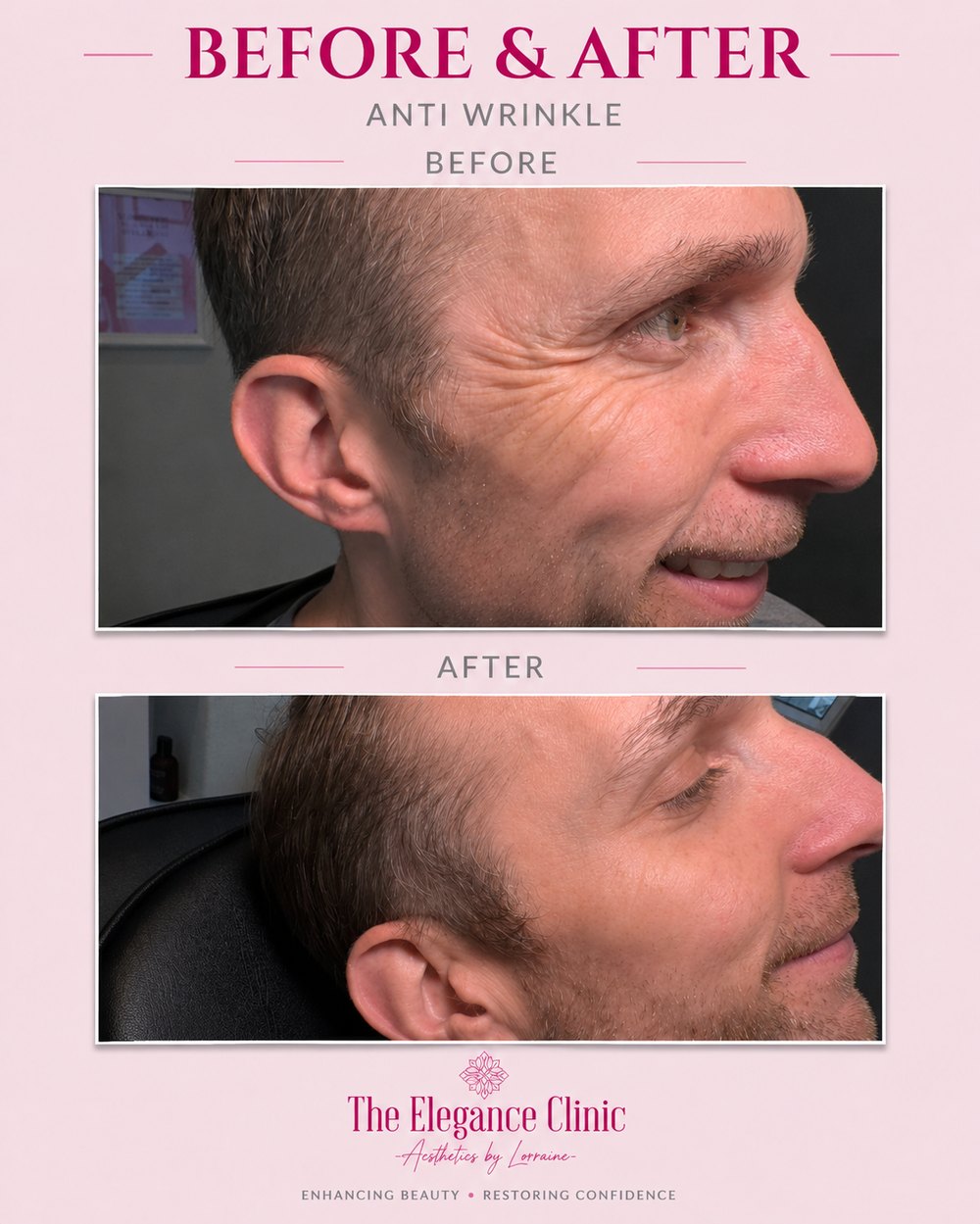 Anti-wrinkle before and after at The Elegance Clinic, Welwyn Garden City