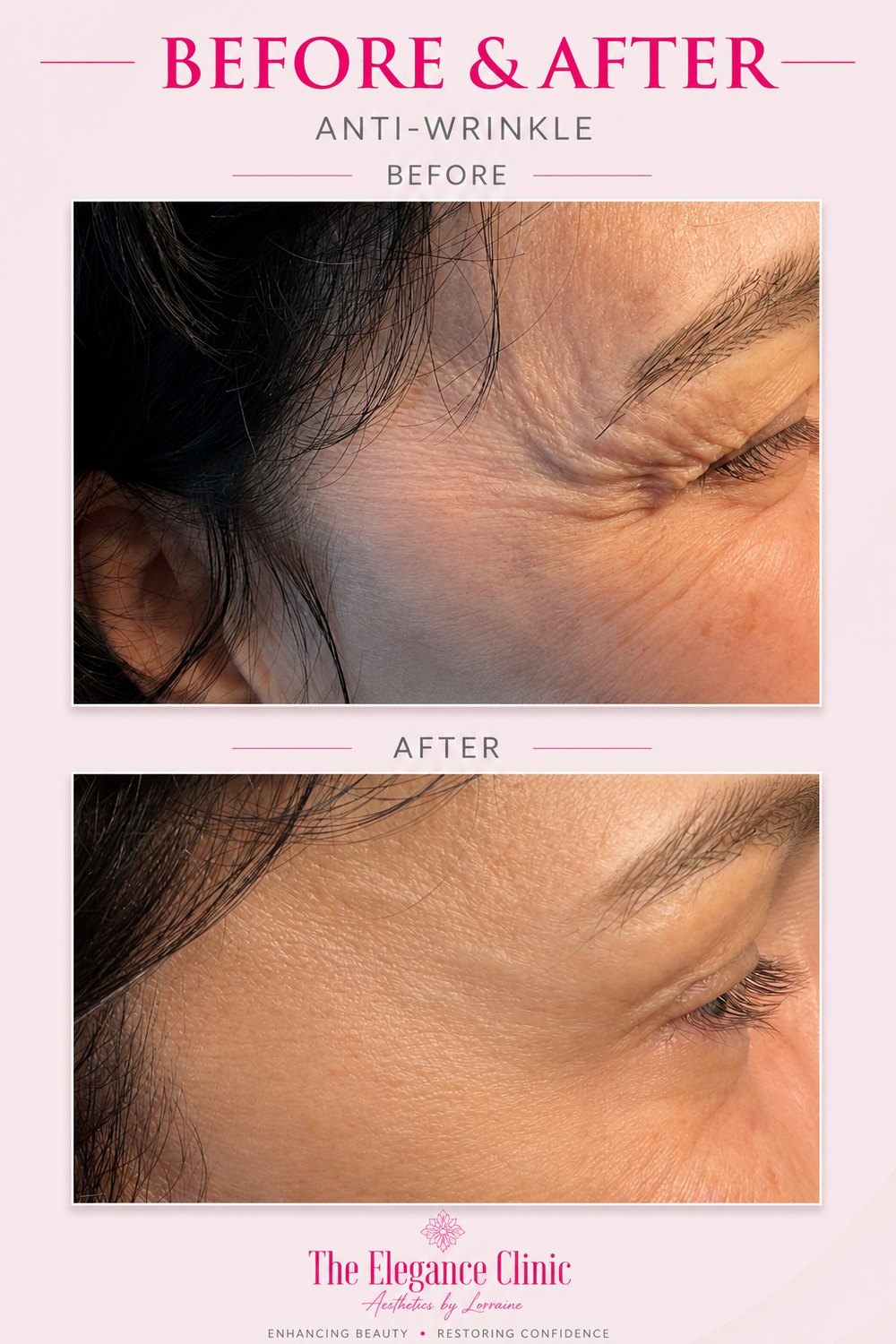 Anti-wrinkle before and after at The Elegance Clinic, Welwyn Garden City