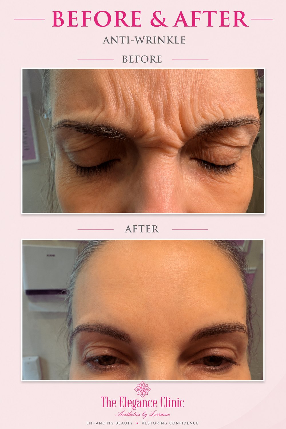 Anti-wrinkle before and after at The Elegance Clinic, Welwyn Garden City