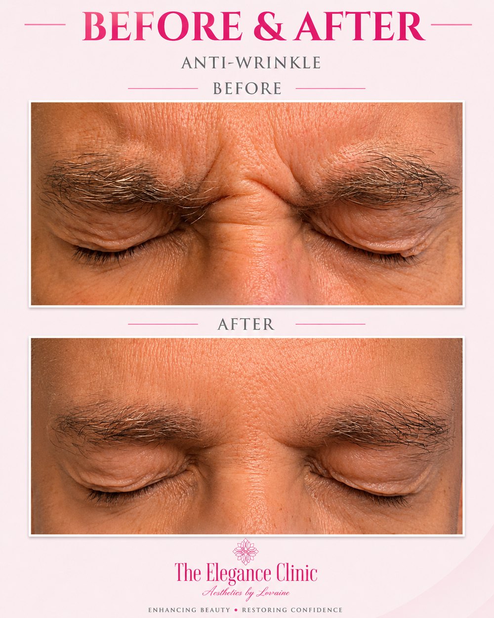 Anti-wrinkle before and after at The Elegance Clinic, Welwyn Garden City