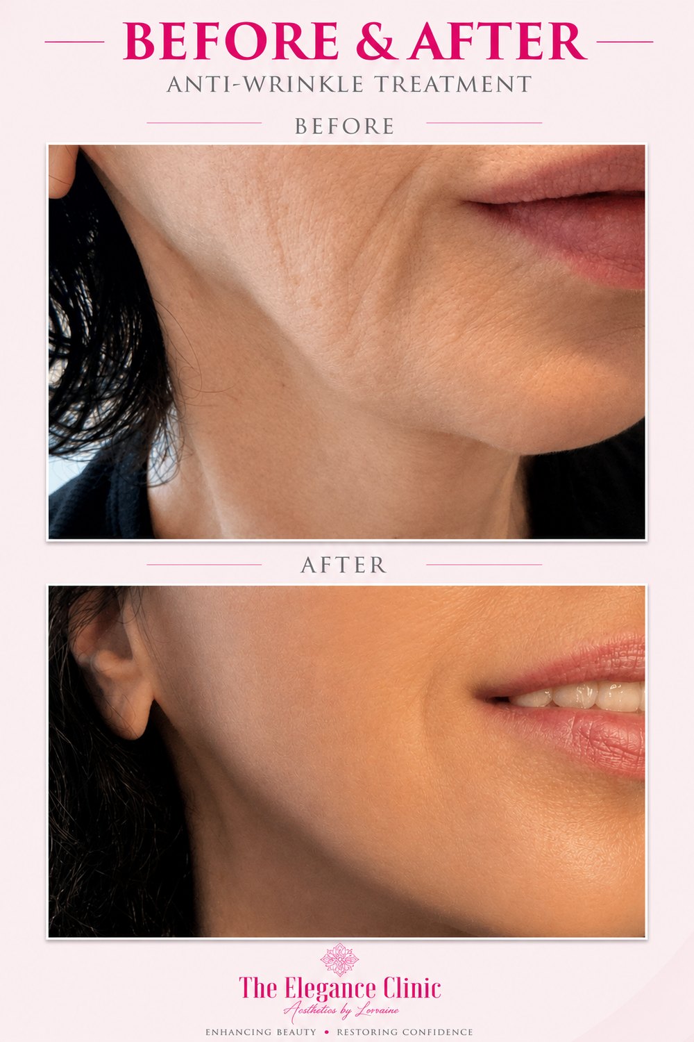 Anti-wrinkle before and after at The Elegance Clinic, Welwyn Garden City