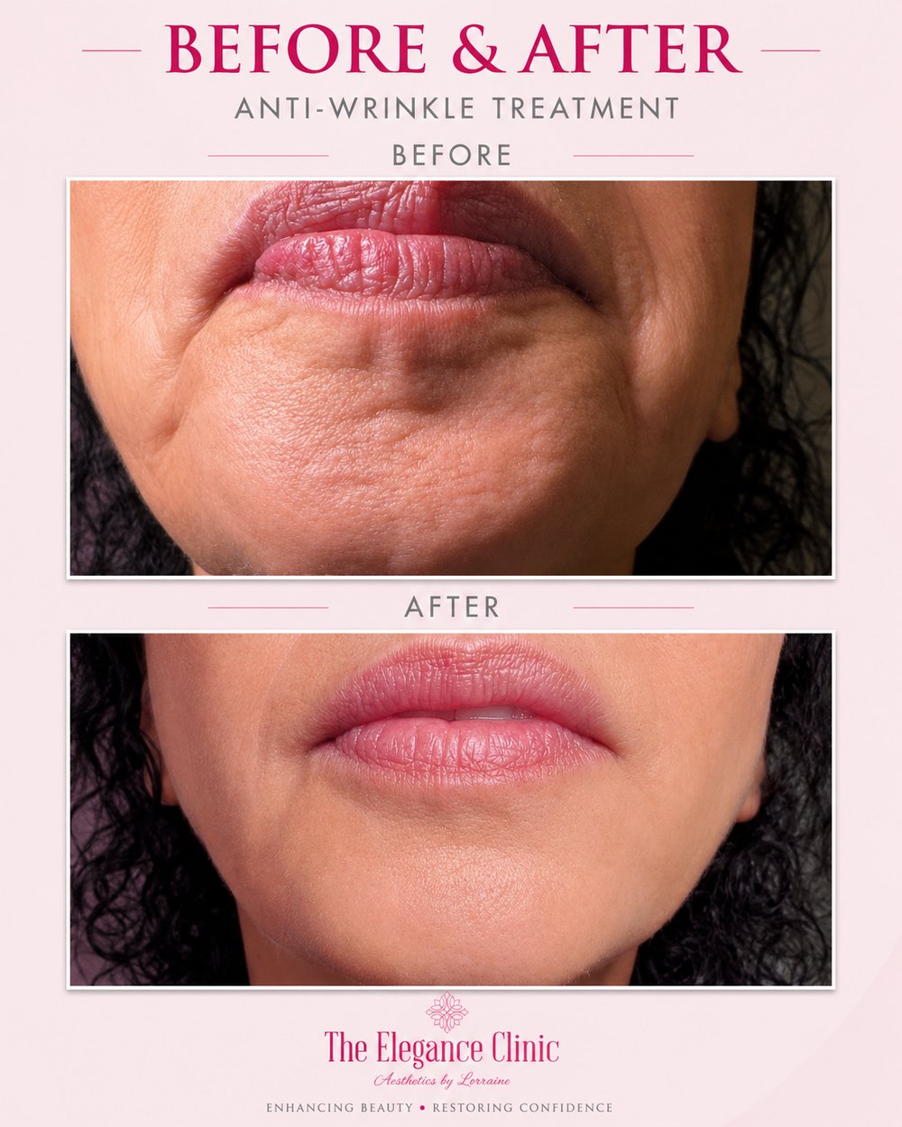 Anti-wrinkle before and after at The Elegance Clinic, Welwyn Garden City
