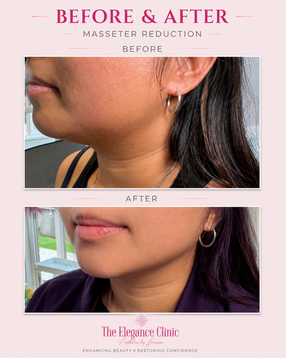 Anti-wrinkle before and after at The Elegance Clinic, Welwyn Garden City