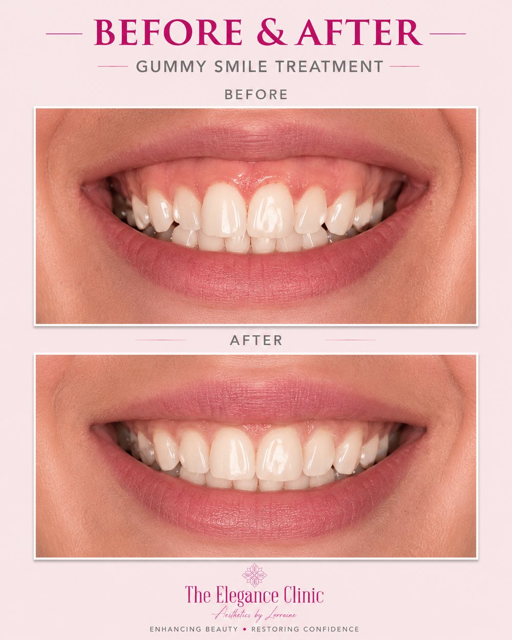Anti-wrinkle before and after at The Elegance Clinic, Welwyn Garden City
