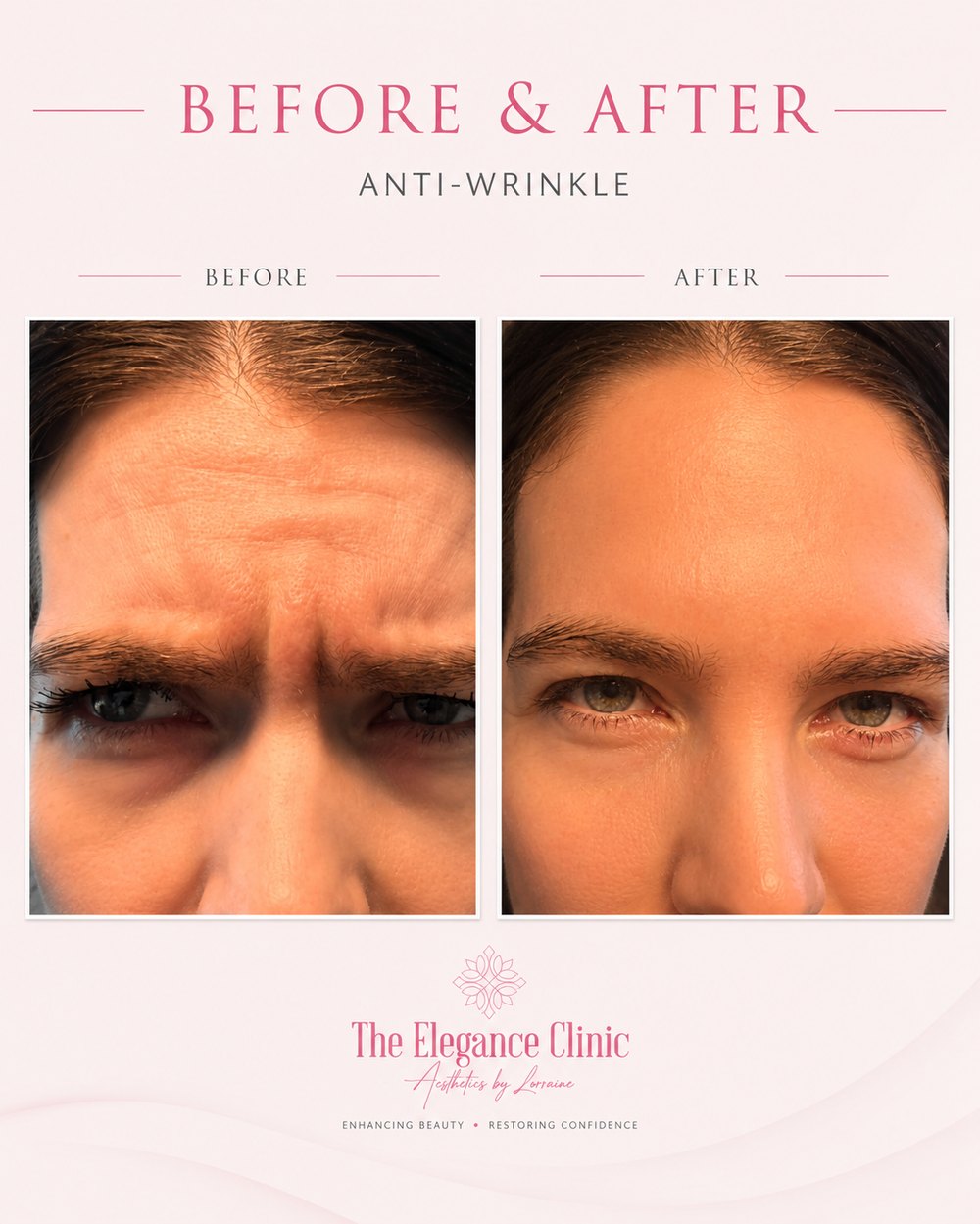 Anti-wrinkle before and after at The Elegance Clinic, Welwyn Garden City