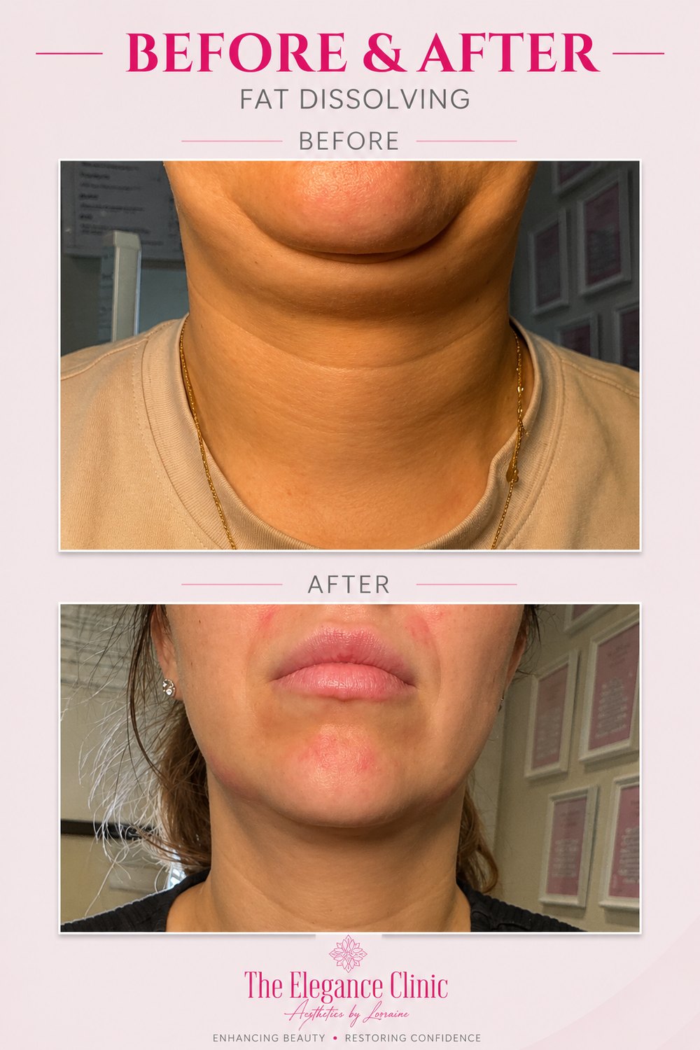 Fat dissolving before and after at The Elegance Clinic, Welwyn Garden City