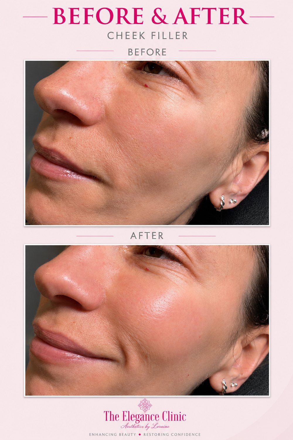 Dermal filler before and after at The Elegance Clinic, Welwyn Garden City