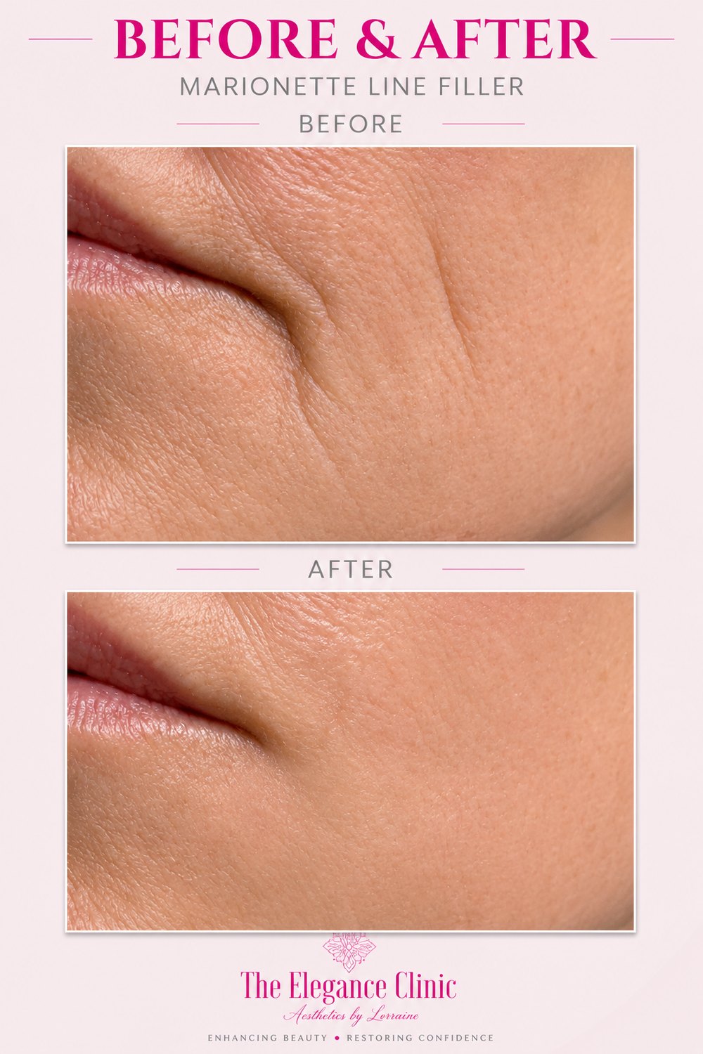 Dermal filler before and after at The Elegance Clinic, Welwyn Garden City
