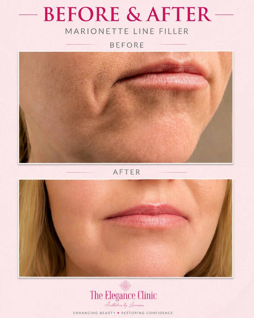 Dermal filler before and after at The Elegance Clinic, Welwyn Garden City