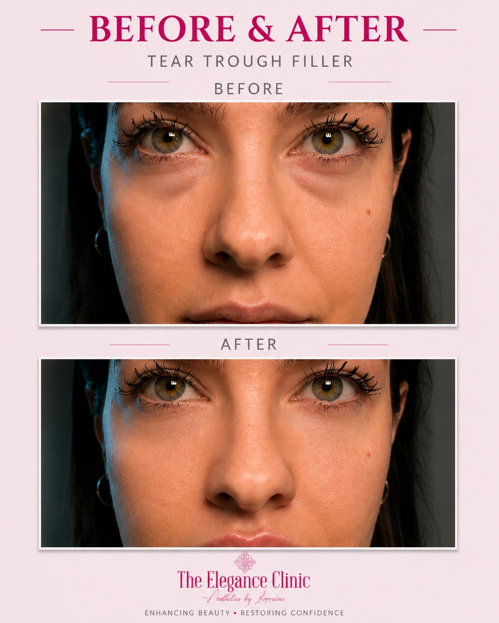 Dermal filler before and after at The Elegance Clinic, Welwyn Garden City