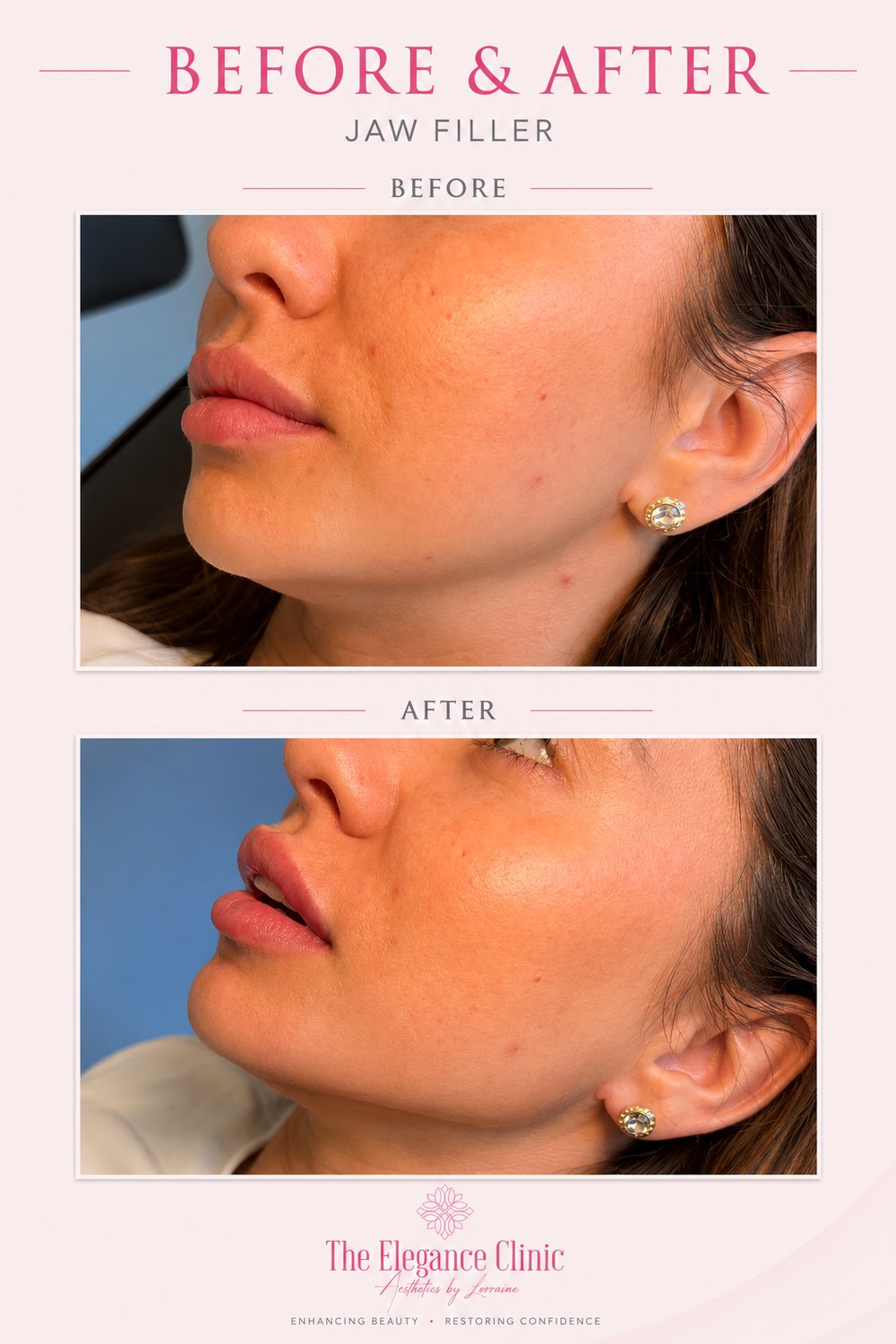 Dermal filler before and after at The Elegance Clinic, Welwyn Garden City