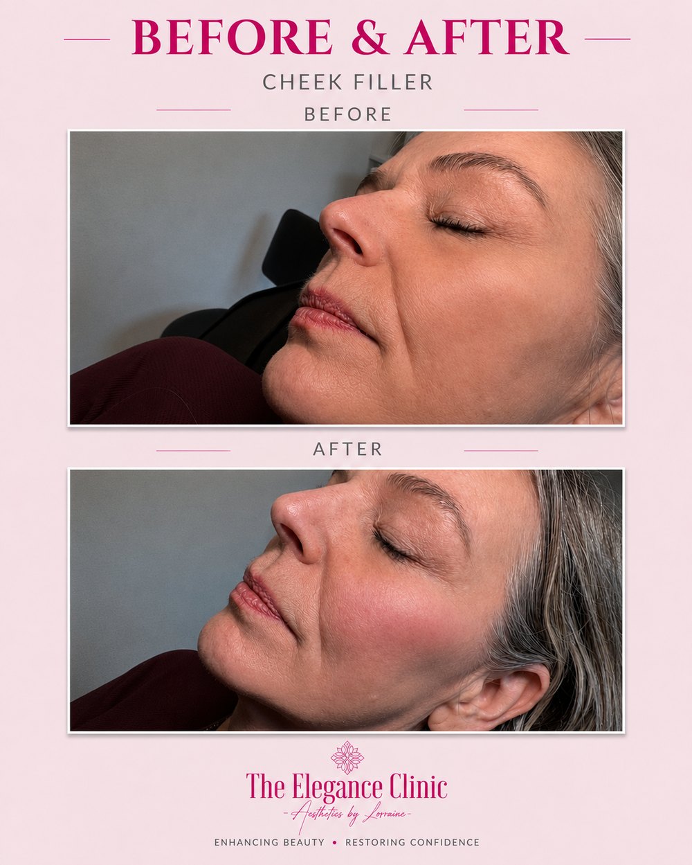 Dermal filler before and after at The Elegance Clinic, Welwyn Garden City