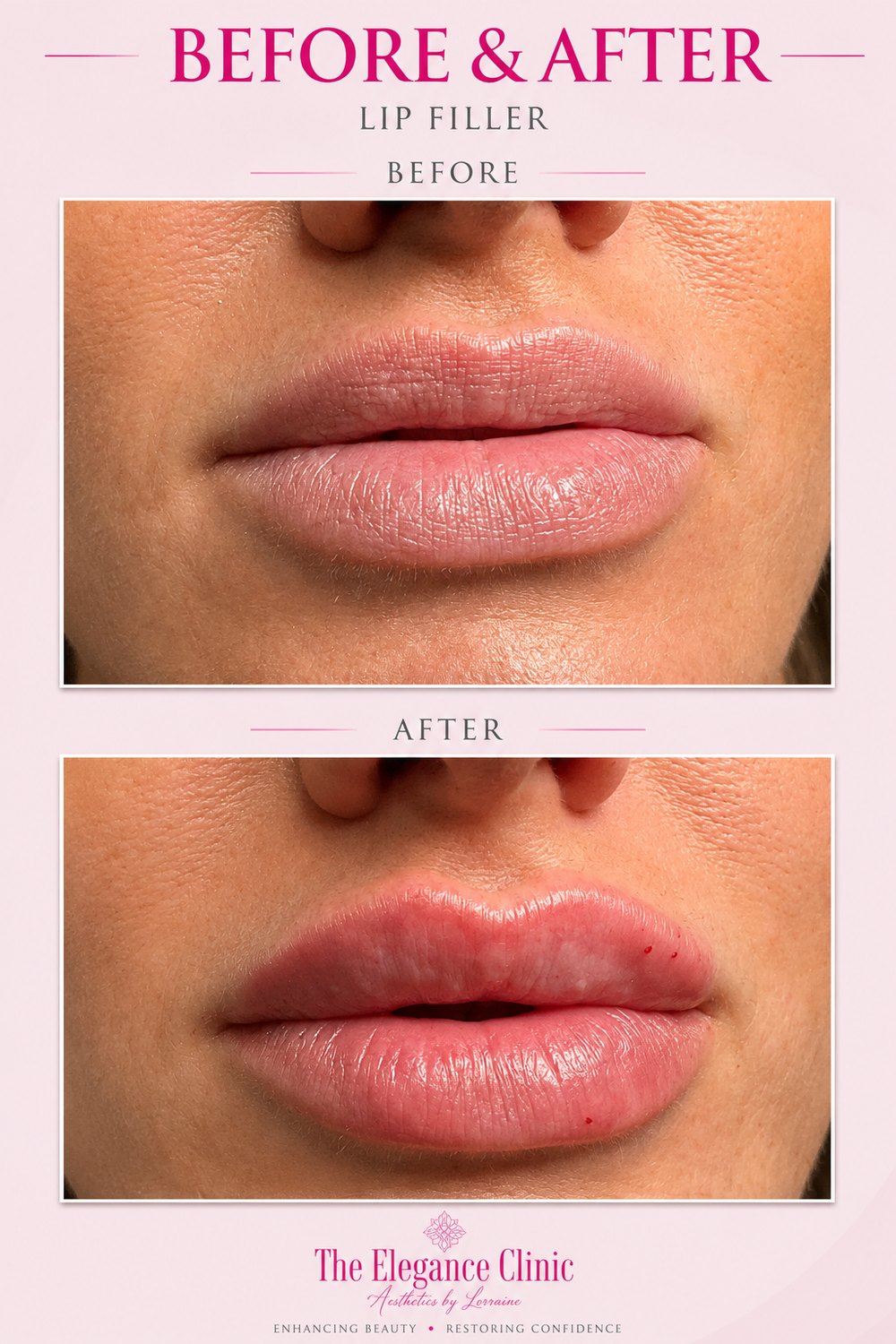 Lip filler before and after at The Elegance Clinic, Welwyn Garden City