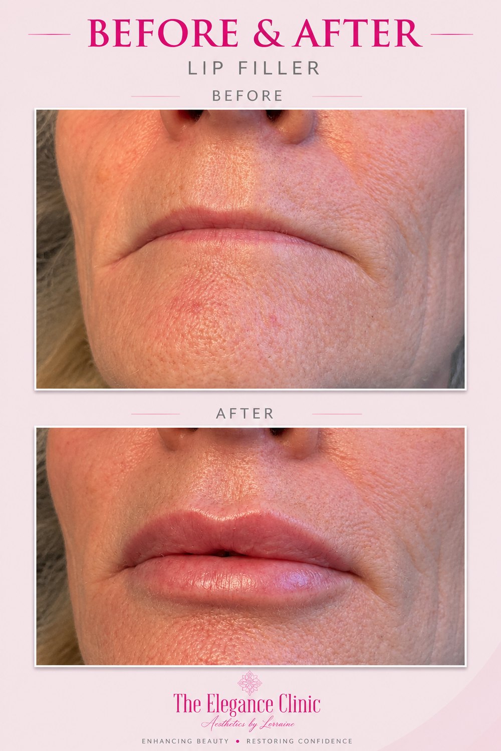 Lip filler before and after at The Elegance Clinic, Welwyn Garden City