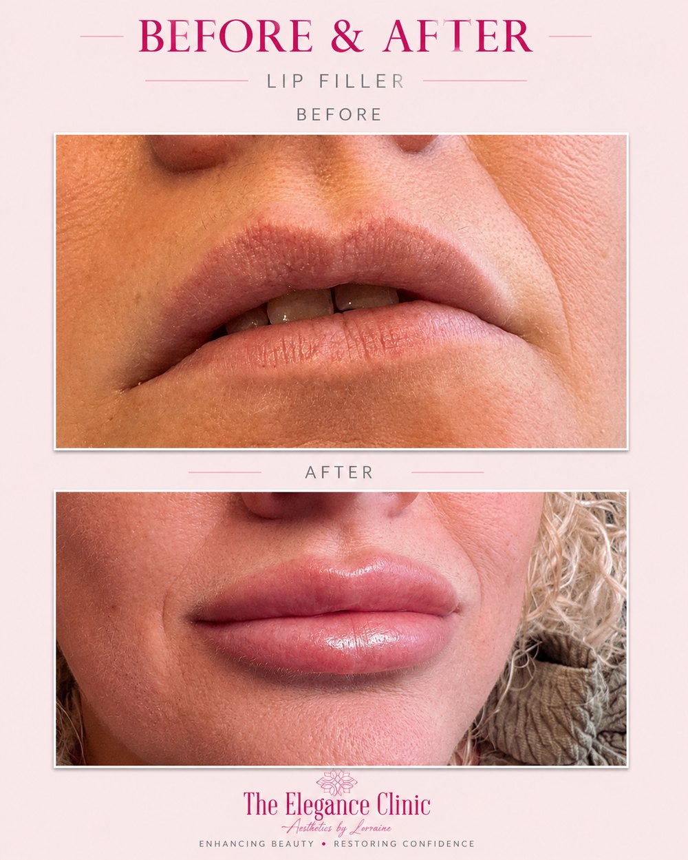 Lip filler before and after at The Elegance Clinic, Welwyn Garden City