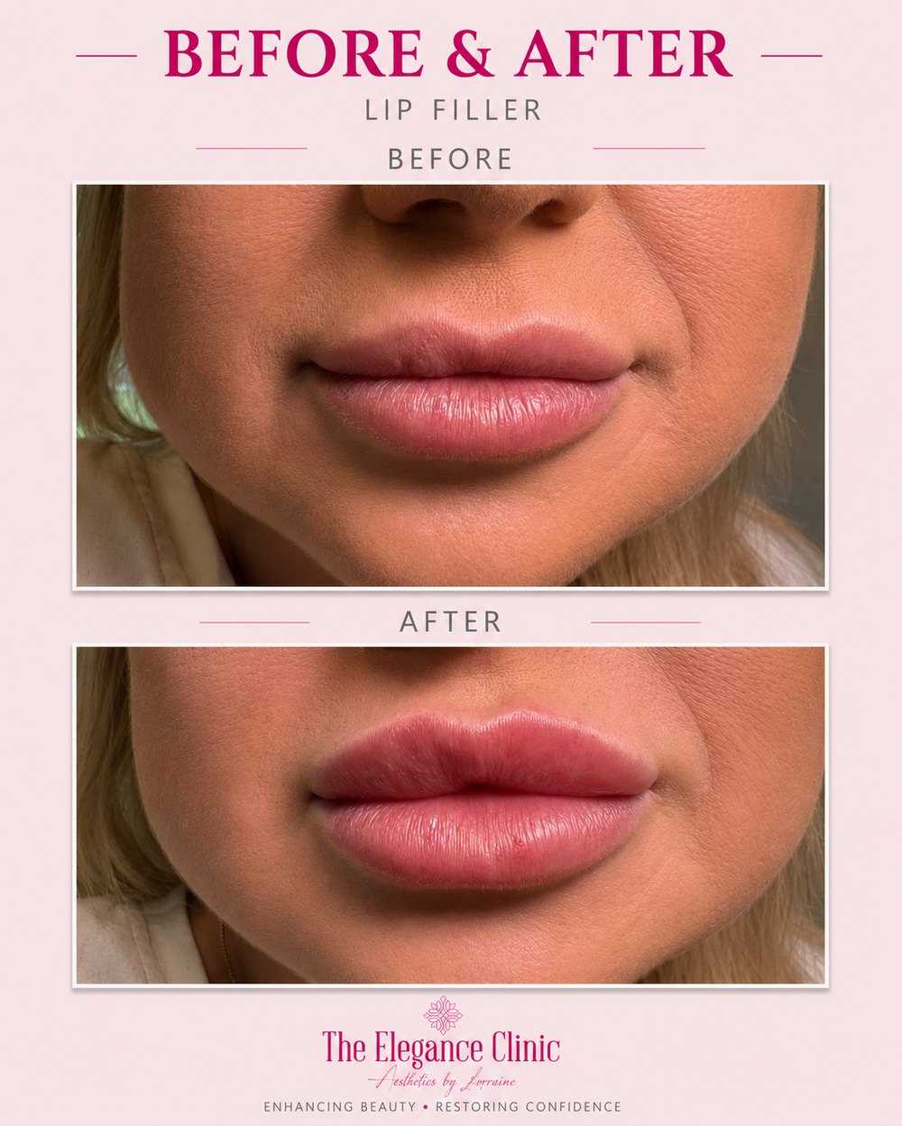 Lip filler before and after at The Elegance Clinic, Welwyn Garden City