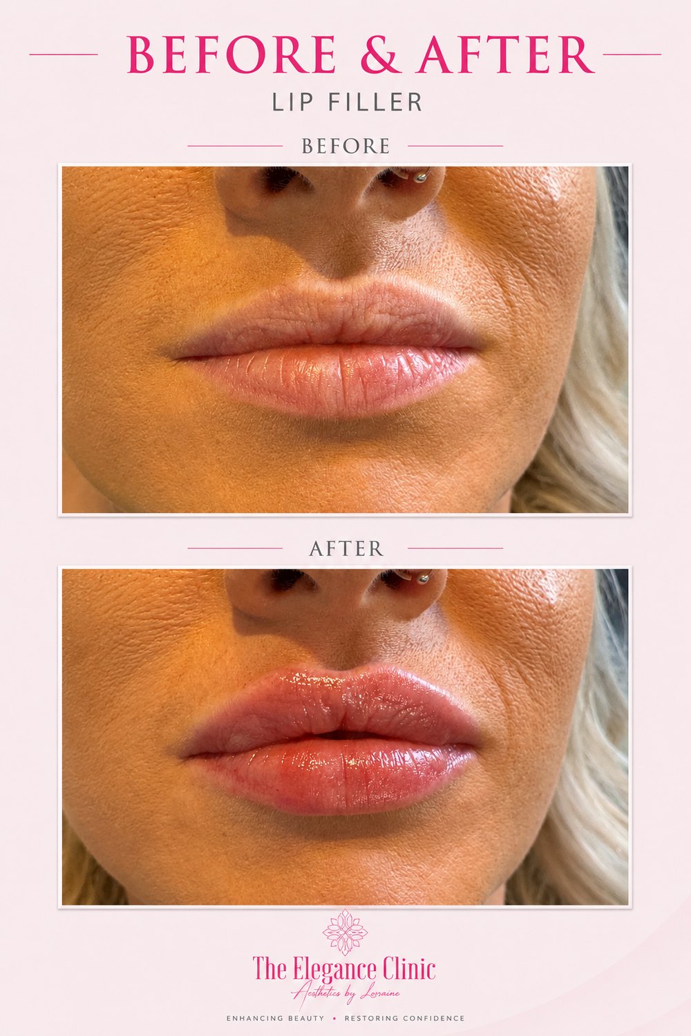 Lip filler before and after at The Elegance Clinic, Welwyn Garden City