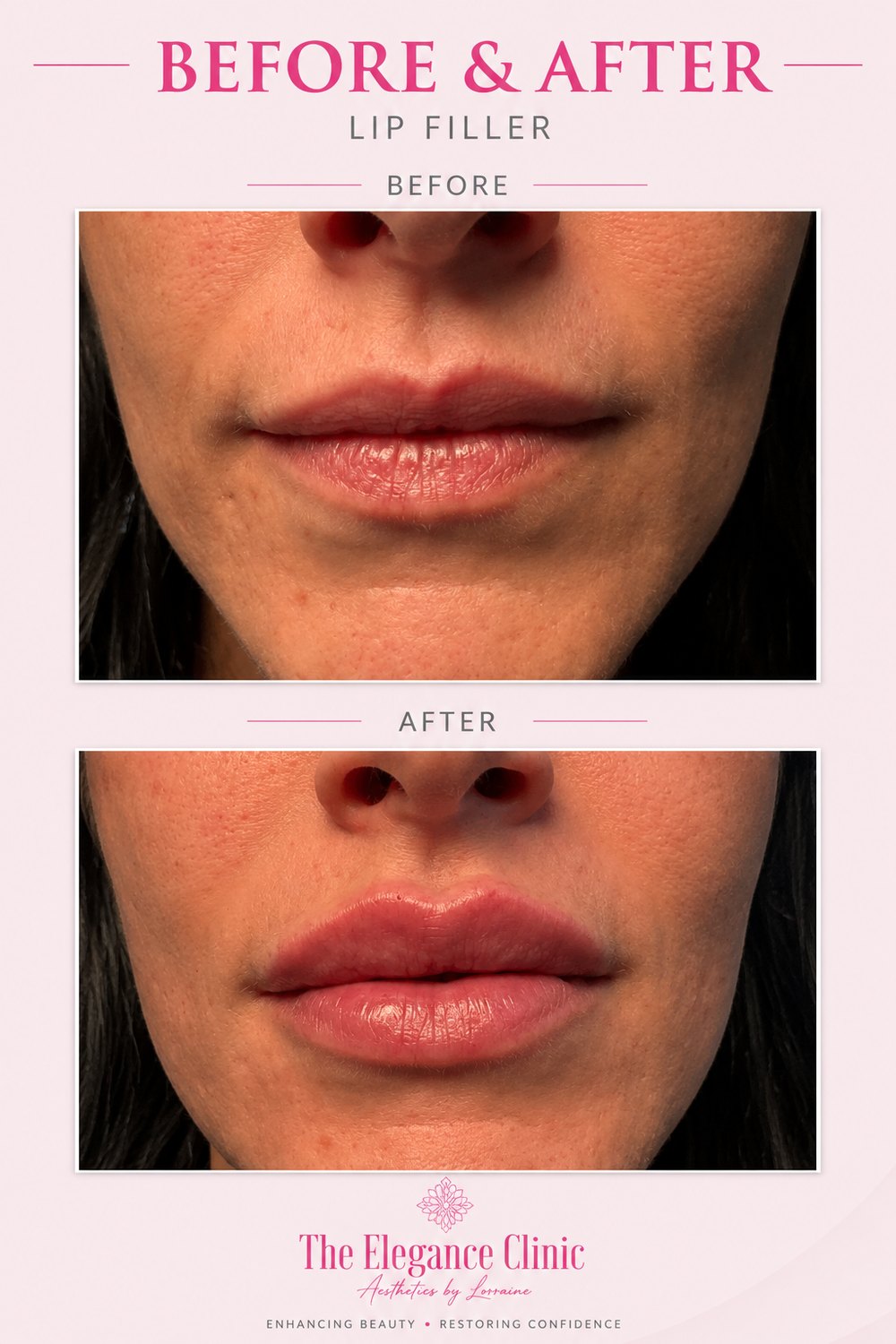 Lip filler before and after at The Elegance Clinic, Welwyn Garden City