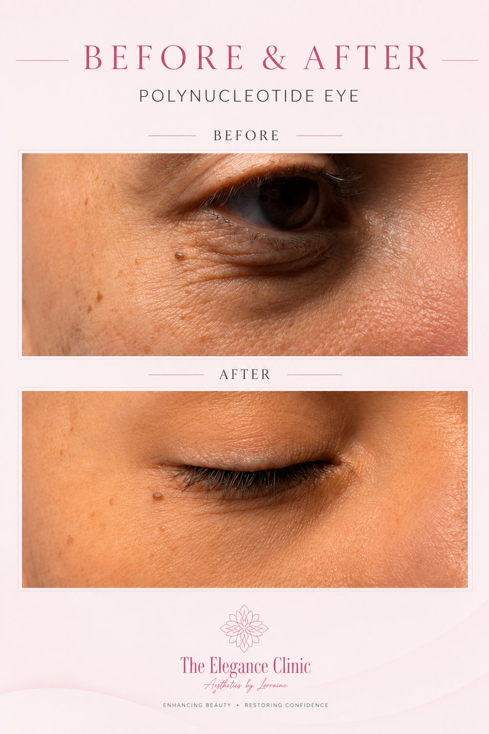 Polynucleotide under-eye before and after at The Elegance Clinic, Welwyn Garden City