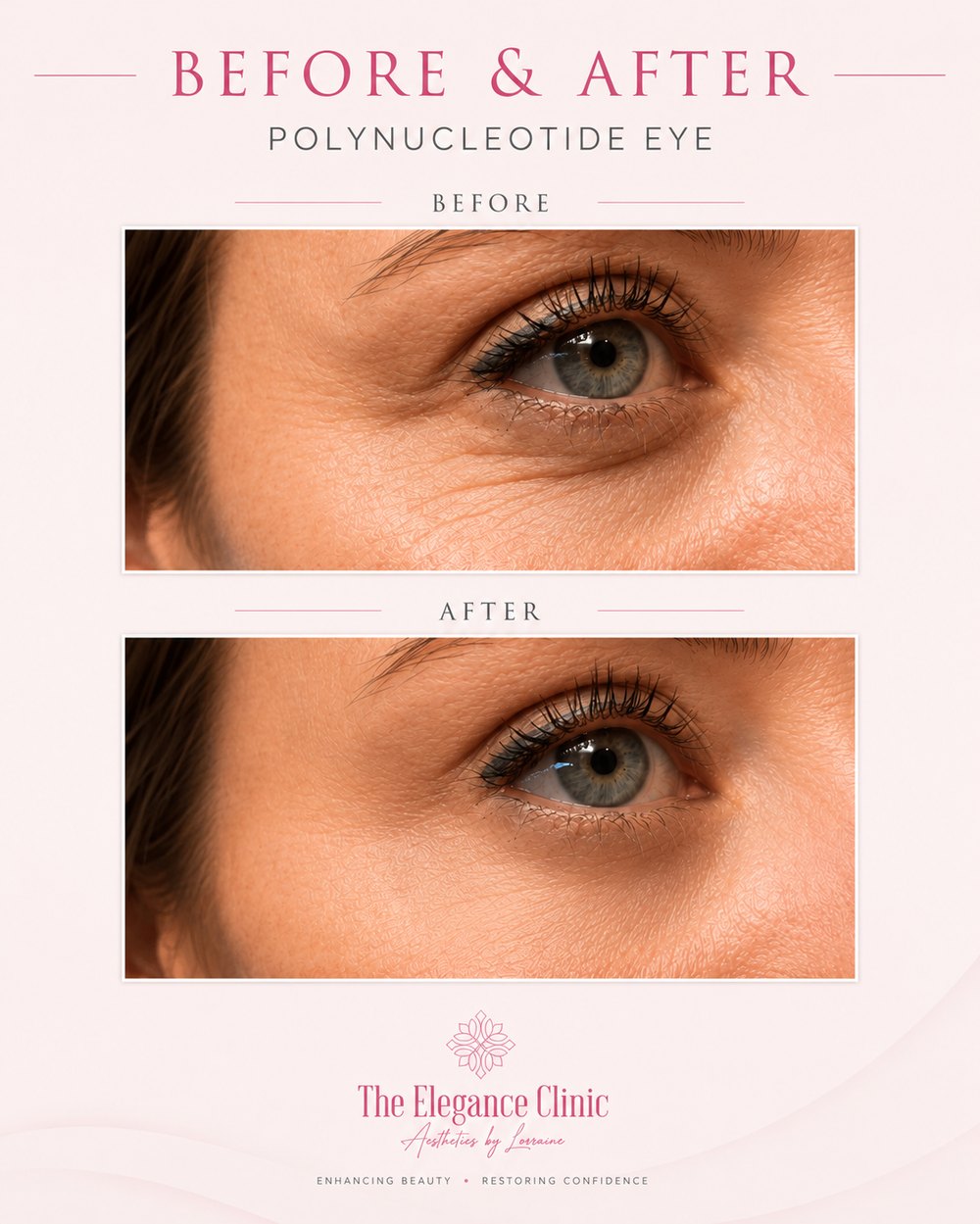 Polynucleotide under-eye before and after at The Elegance Clinic, Welwyn Garden City