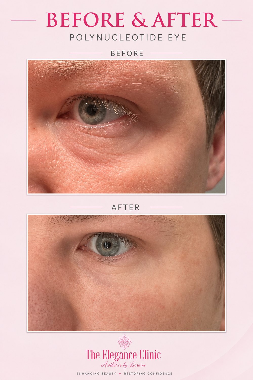 Polynucleotide under-eye before and after at The Elegance Clinic, Welwyn Garden City