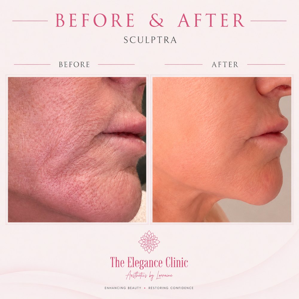 Sculptra before and after at The Elegance Clinic, Welwyn Garden City