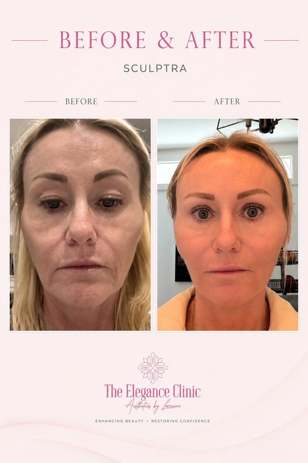 Sculptra before and after at The Elegance Clinic, Welwyn Garden City