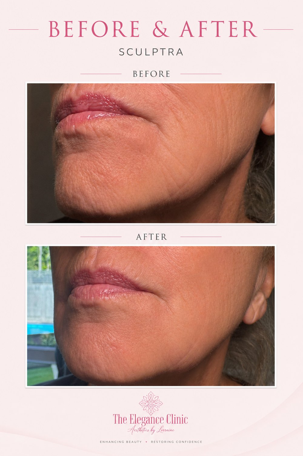 Sculptra before and after at The Elegance Clinic, Welwyn Garden City