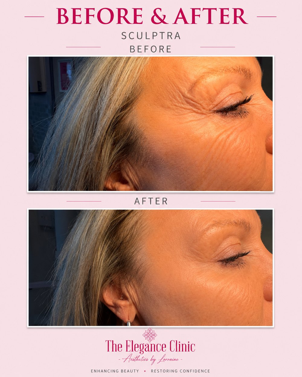 Sculptra before and after at The Elegance Clinic, Welwyn Garden City