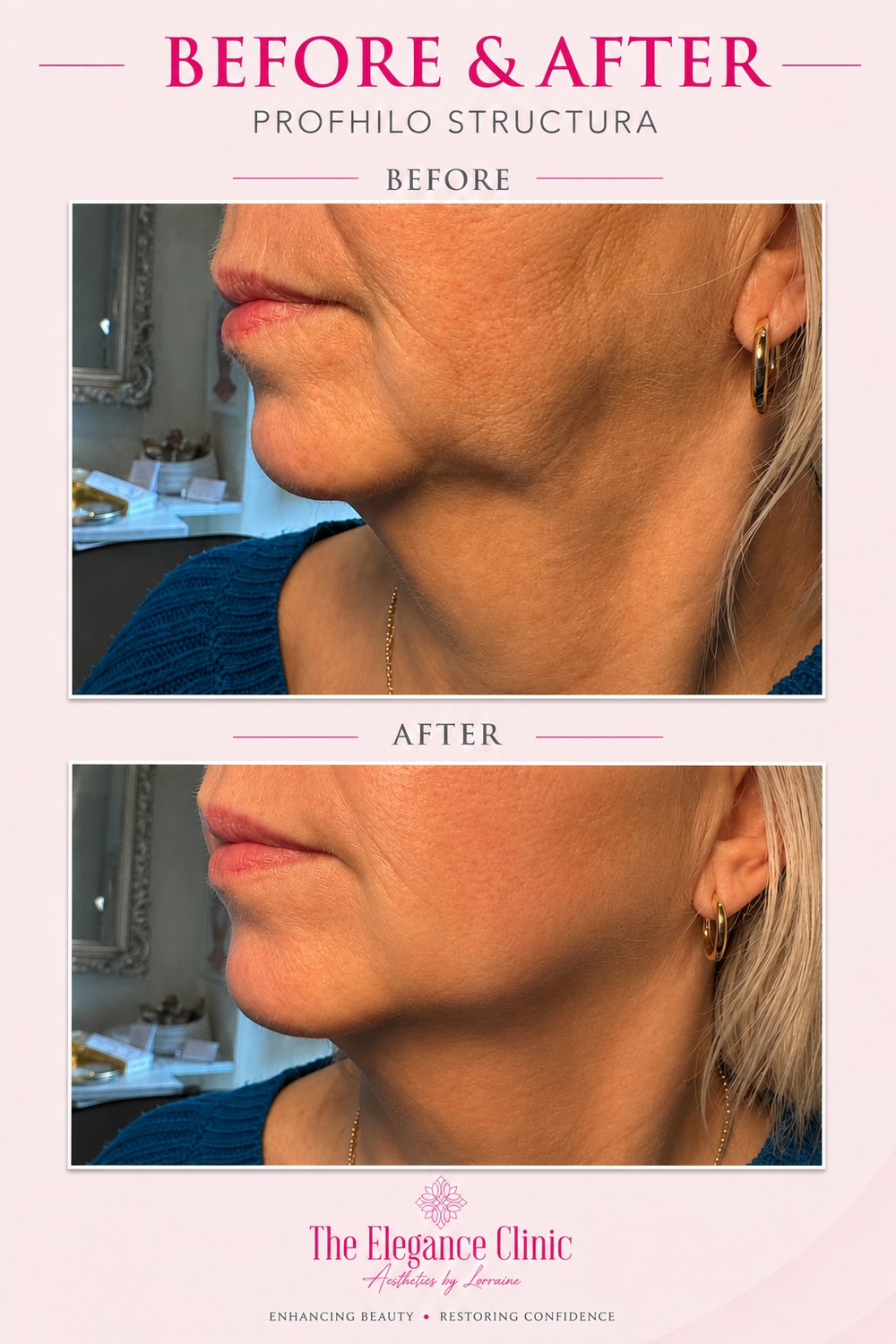 Skin booster before and after at The Elegance Clinic, Welwyn Garden City