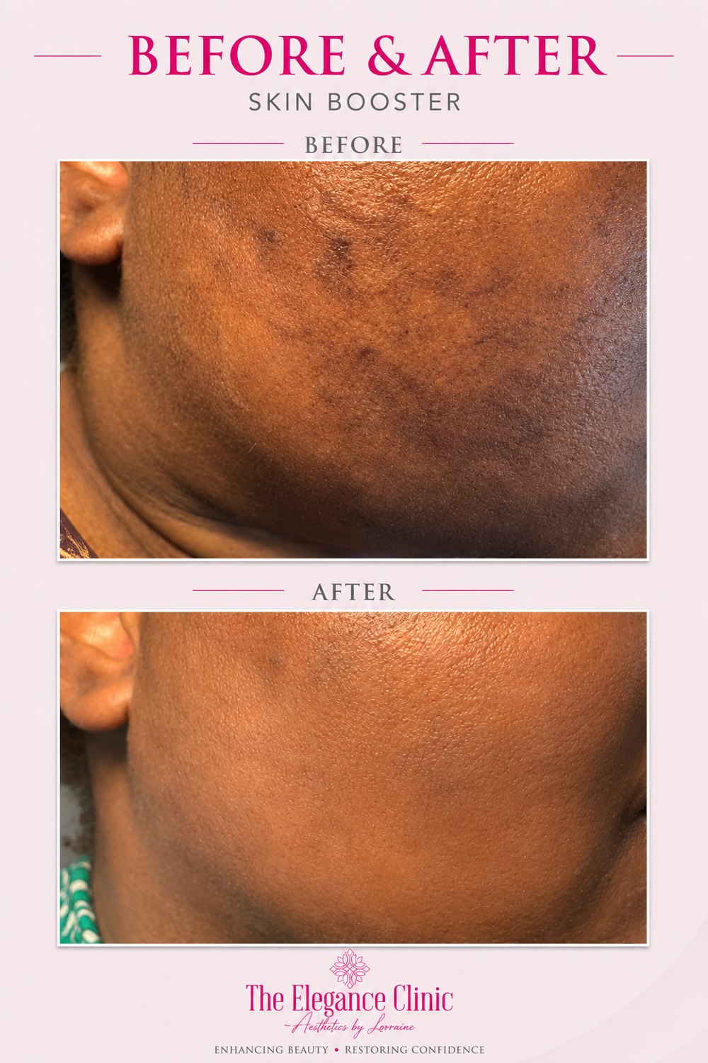 Skin booster before and after at The Elegance Clinic, Welwyn Garden City