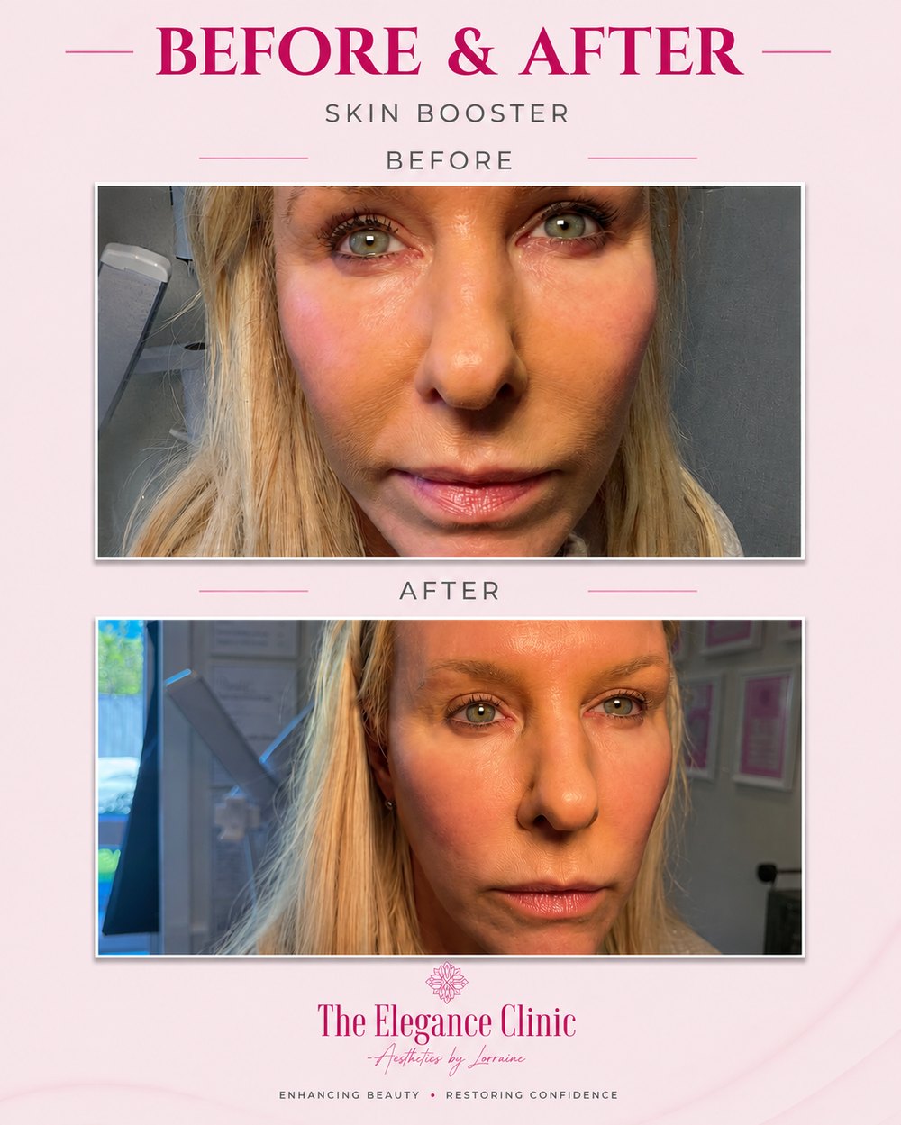 Skin booster before and after at The Elegance Clinic, Welwyn Garden City