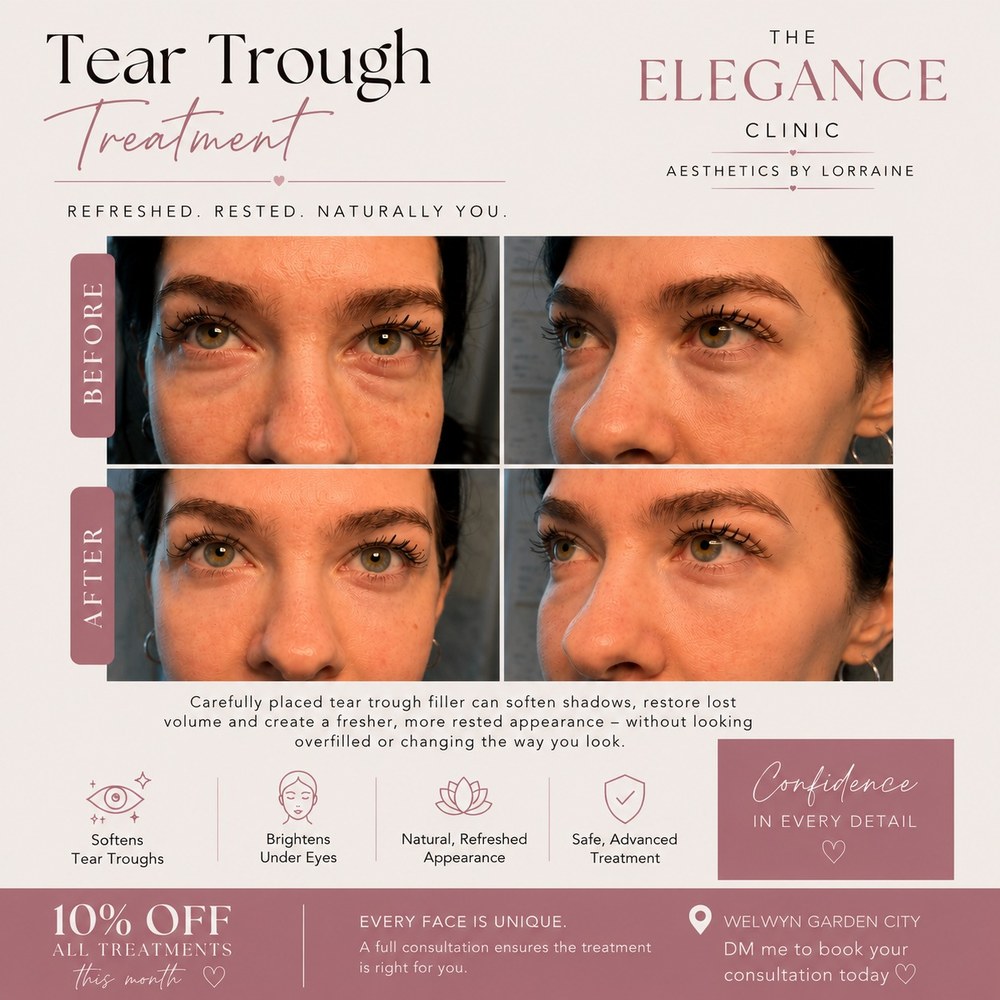 Tear trough treatment before and after at The Elegance Clinic, Welwyn Garden City — softening under-eye shadows and hollows for a fresher, rested look