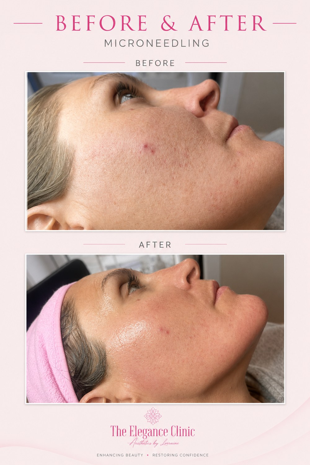Microneedling before and after at The Elegance Clinic, Welwyn Garden City