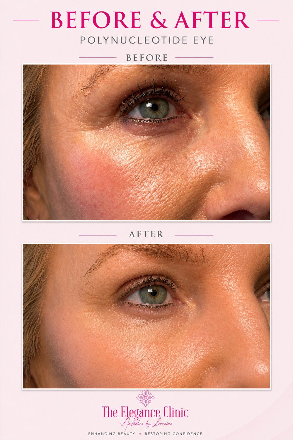 Polynucleotides before and after at The Elegance Clinic, Welwyn Garden City
